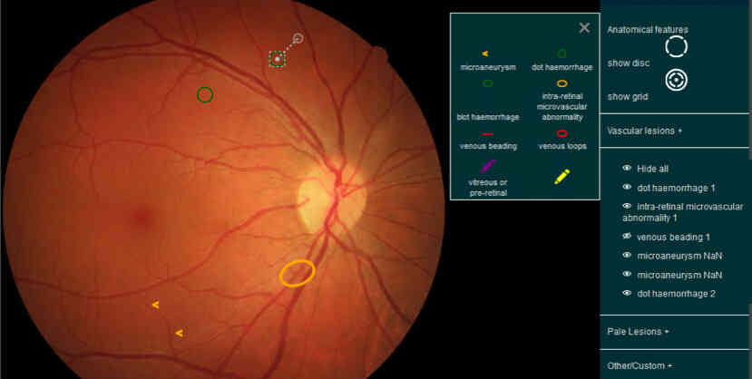 Fundus lesion annotation tool